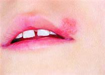 اطلاعات خواندني درباره تبخال