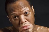 علل ،پيشگيري و در مان پيسي