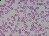 کم خوني فقر آهن کم خوني فقر آهن