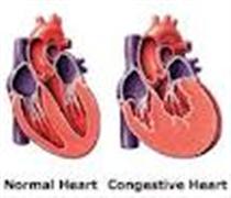 نارسايي احتقاني قلب نارسايي احتقاني قلب