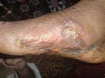 درمان زخم پاي بيمار ديابتي