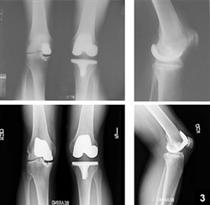 استئوآرتريت قابل پيشگيري است